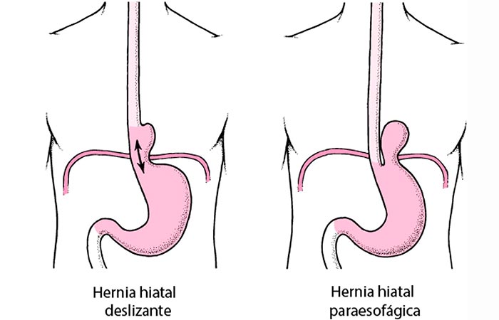 Manejo de precisión en hernias hiatales y ERGE: del diagnóstico funcional a la cirugía robótica